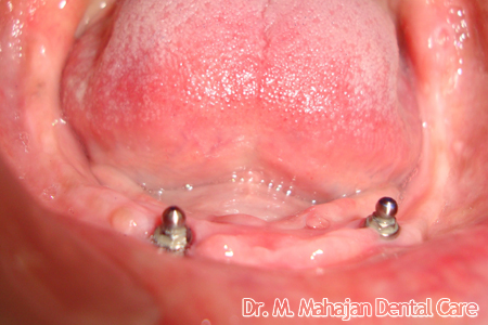 Implant OverDenture - Post