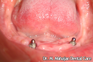 Implant OverDenture - Post