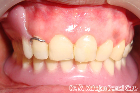 Implant OverDenture - Post