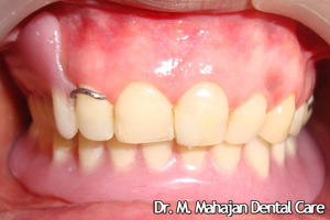 Implant OverDenture - Post