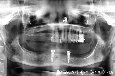 Implant OverDenture - Post