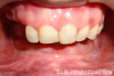 Implant OverDenture - Pre