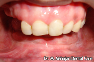 Implant OverDenture - Pre