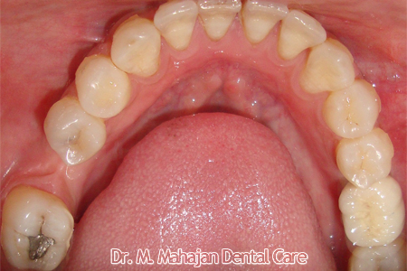 Single Tooth Implant