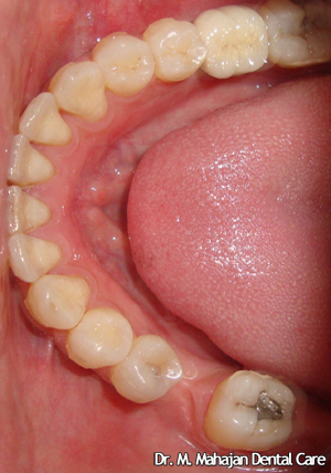 Single Tooth Implant