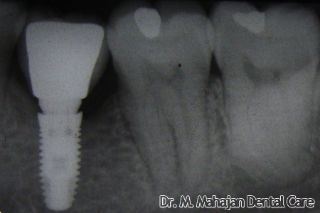 Single Tooth Implant