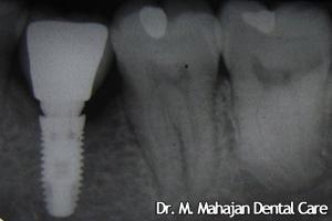 Single Tooth Implant